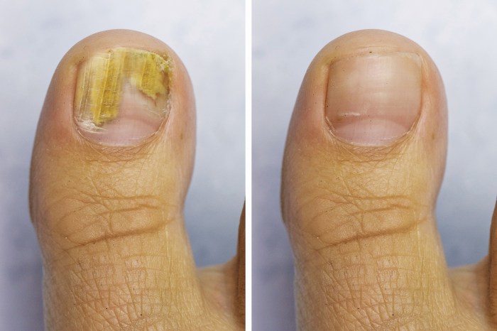 Fungus toenail ftempo pedicure