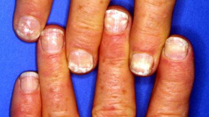 Nails white spots get rid means really