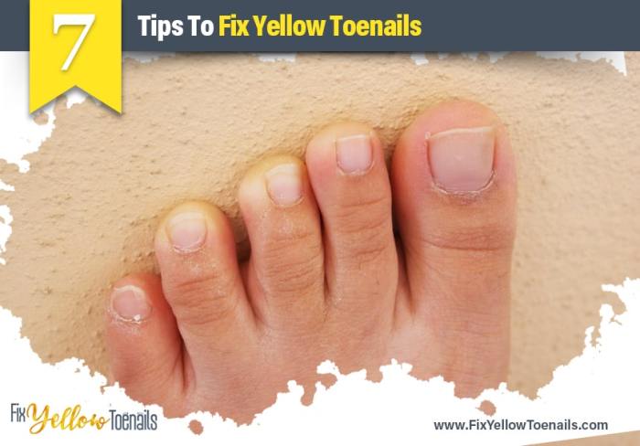 Yellow toenails from nail polish