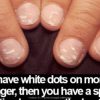 White Spots on Nails After Polish Removal