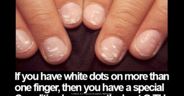 White spots on nails after removing polish