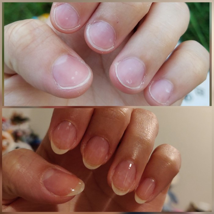 White spots on nails after removing polish