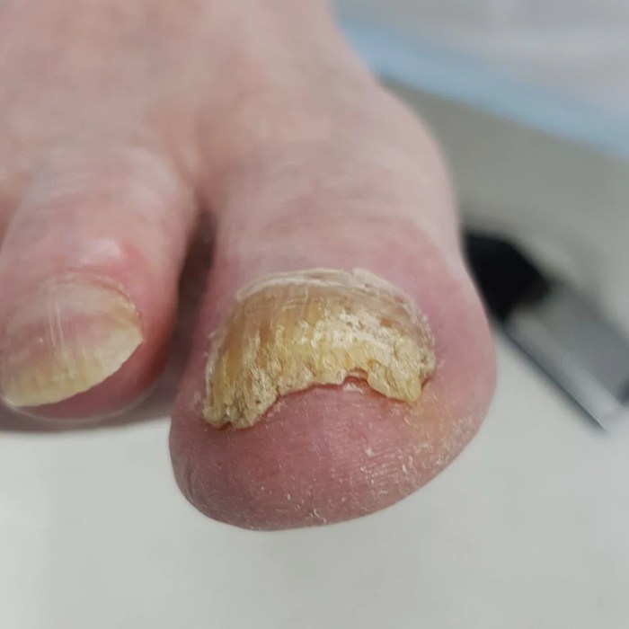 Yellow toenails from nail polish